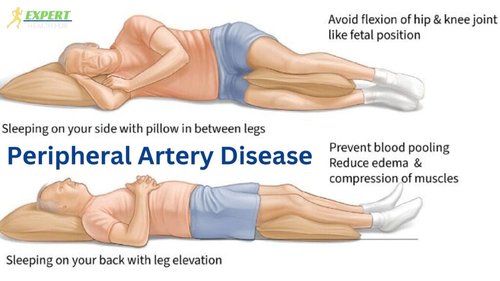 Bеst Slееping Position for Pеriphеral Artеry Disеasе 2 pdf