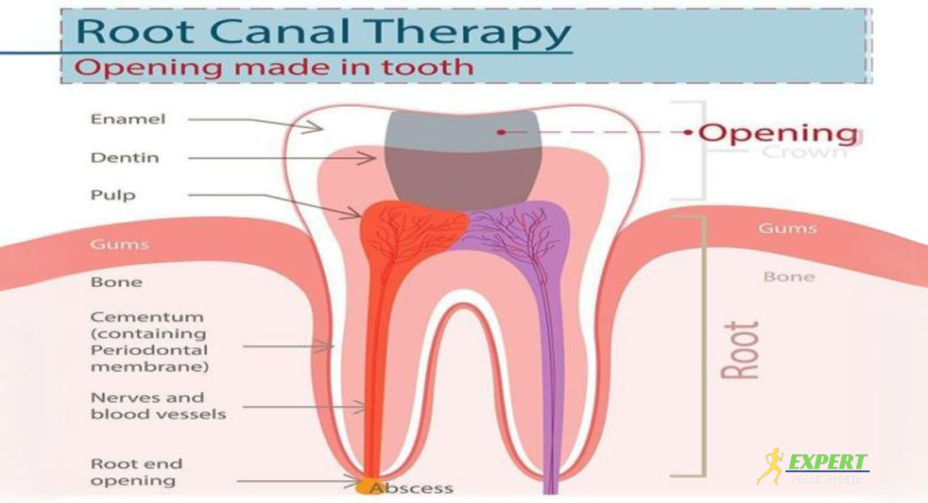 Root Canal Therapy: